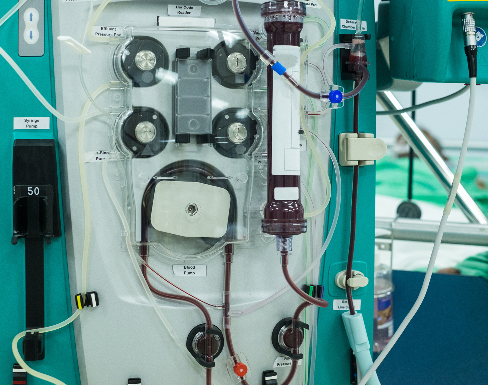 Blóðskilunarvél, er að hreinsa blóð úr manneskju með nýrnabilun sem liggur á rúmi bakvið vélina.